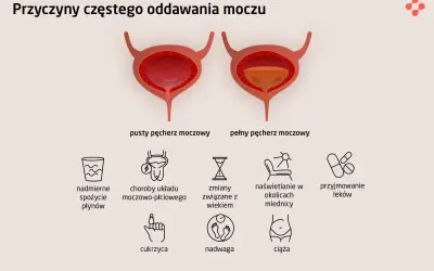 Ilustracja pokazuje przyczyny problemów z oddawaniem moczu u mężczyzn: nadmierne picie, choroby układu moczowo-płciowego, wiek, naświetlanie, leki, cukrzyca, nadwaga, ciąża.