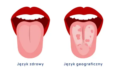 Dwa języki: jeden zdrowy, gładki, drugi z plamami, przypominający mapę. To obraz języka geograficznego.