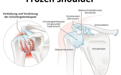 Schultergelenk mit verdickter Kapsel und entzündetem proc coracoideus. Veranschaulicht die Verklebung der Schultergelenkkapsel bei Frozen Shoulder.