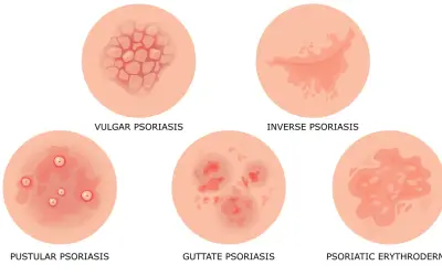 Ilustracja przedstawia różne rodzaje łuszczycy: plackowatą, odwróconą, krostkową, kropelkowatą i erytrodermię łuszczycową.