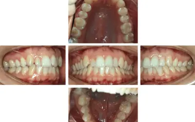 Denti con malocclusione 2 classe, in attesa di trattamento Invisalign.