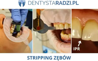 Stripping zębów: przed zabiegiem z użyciem narzędzi i po, widoczna poprawa przestrzeni międzyzębowych (IPR).