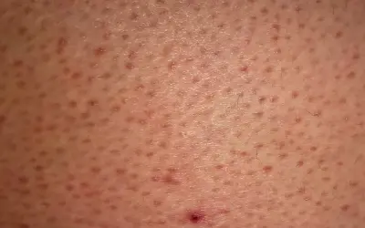 Skóra z licznymi drobnymi grudkami i zaczerwienieniami, charakterystycznymi dla rogowacenia mieszkowego (keratosis pilaris).