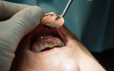 Zgorzel zęba powoduje opuchliznę dziąseł. Dentysta bada jamę ustną pacjenta lusterkiem.
