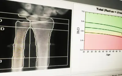 Wynik badania gęstości kości: analiza radiologiczna przedramienia z wykresem BMD w funkcji wieku.