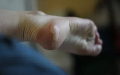 Gros plan sur un pied avec une phlyctène sur le talon, nécessitant un traitement.