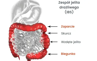 Jelito drażliwe: Objawy, typy, czerwone flagi. Kiedy do lekarza?