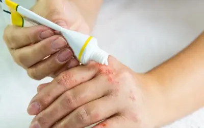 Osoba aplikuje dermovate maść na suchą, zaczerwienioną skórę dłoni.
