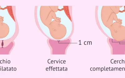 Illustrazione del travaglio: cervice non dilatata, dilatata di 1 cm e completamente dilatata (10 cm). Il cerchiaggio cervicale è una procedura per sostenere una cervice debole.