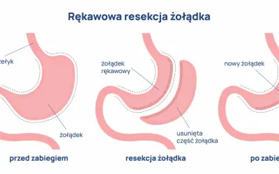 Ilustracja pokazuje proces rękawowej resekcji żołądka, procedury bariatrycznej, która zmniejsza jego rozmiar.