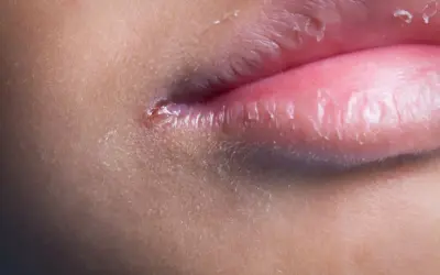Close-up di labbra con pelle secca e screpolata, e una piccola lesione. Si nota una lieve leucoplachia labbra.
