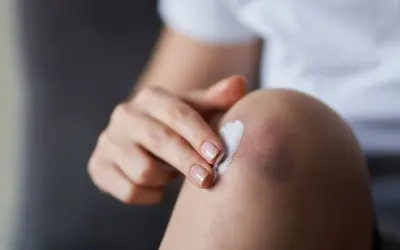Eine Hand trägt Salbe auf ein blaues Fleck am Knie auf. Die **Prellung am Knie** wird vorsichtig behandelt.