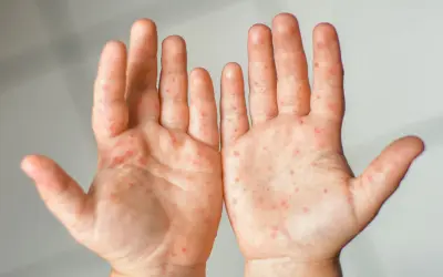 Hautausschlag an den Händen, möglicherweise durch eine Vitamin C-Allergie verursacht. Rote Flecken auf der Haut.