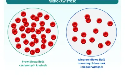 Porównanie prawidłowej i nieprawidłowej ilości czerwonych krwinek, czyli elementów morfotycznych krwi, w kontekście niedokrwistości.