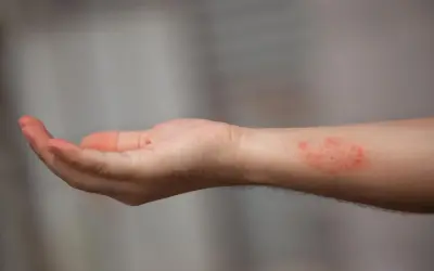 Poignet présentant une dartre cutanée rouge et irritée.