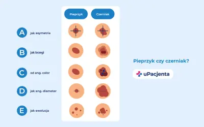 Ilustracja porównująca pieprzyk i czerniaka według kryteriów ABCDE.