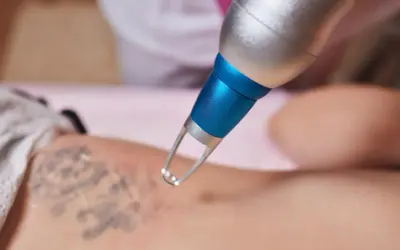 Laserowe usuwanie tatuażu, który stał się blizną. Zabieg przy użyciu nowoczesnego sprzętu.