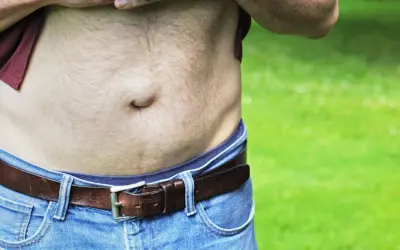 Widoczne objawy przepukliny pępkowej u mężczyzny. Wypukłość w okolicy pępka, widoczna pod podwiniętą koszulką i nad paskiem.