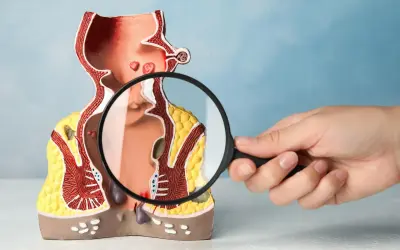 Model anatomiczny przedstawia jelito grube z widocznymi zmianami, które mogą sugerować raka odbytnicy. Lupa powiększa szczegóły.