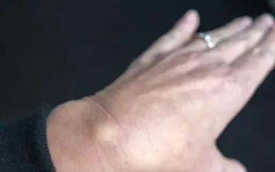 Ein kleiner, gelblicher Schleimbeutel am Handgelenk einer Person mit einem Ring.