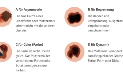 Hautveränderungen: Asymmetrie, unregelmässige Ränder, Farbwechsel und Dynamik sind Anzeichen für schwarzen Hautkrebs (Vorstufe).