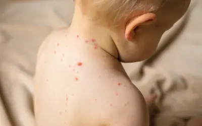 Enfant atteint de varicelle, avec des boutons rouges sur le dos et le cou. Conseils pour aider à comment faire sécher les boutons de varicelle rapidement.