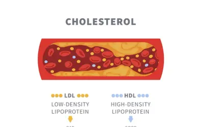Zatkanie tętnicy przez cholesterol LDL, czyli "zły" cholesterol, który gromadzi się w naczyniach krwionośnych.