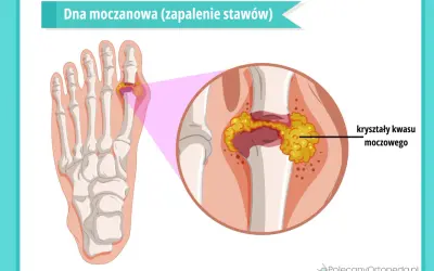 Dna moczanowa: kryształy kwasu moczowego gromadzą się w stawie palucha, powodując zapalenie.