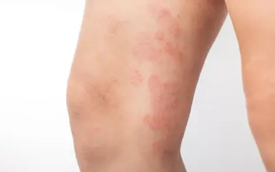Plaques rouges et squameuses sur la cuisse, indiquant un **eczéma cuisse**. La peau semble irritée et sèche.