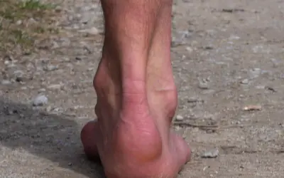 Detailaufnahme eines Fußes mit einer sichtbaren Haglundferse. Möglicherweise nach einer Haglundferse OP.