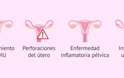 Ilustración de útero con DIU, deslizamiento, perforación, enfermedad inflamatoria pélvica e infección uterina. Reposo tras colocar el DIU Mirena.