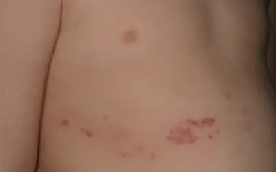 Barnets hud visar knottrig hud med röda utslag, troligen bältros.