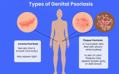 Illustration des types de psoriasis génital, y compris le psoriasis inversé et le psoriasis en plaques, qui peuvent affecter le pénis.