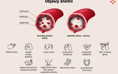 Anemia objawy: bladość skóry, spadek energii, szumy uszne, nerwowość, zmęczenie, bóle głowy, spadek koncentracji, pogorszenie stanu skóry i wypadanie włosów, zaburzenia smaku, przyspieszone bicie serca.