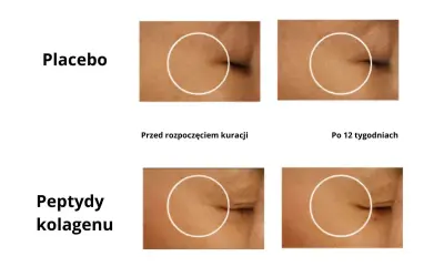 Porównanie efektów kuracji: placebo vs. peptydy kolagenu rybiego. Zmarszczki wokół oka przed i po 12 tygodniach.