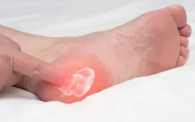 Application d'une crème sur une zone rouge et douloureuse du talon, suggérant une aponévrosite plantaire qui ne guérit pas.