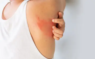Un'eruzione cutanea rossa e pruriginosa sulla spalla, che fa sudare dietro la nuca per il disagio.