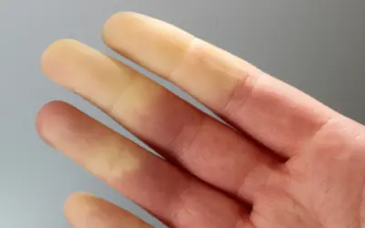 Palce dłoni z widocznymi zmianami koloru, wskazującymi na zespół Raynauda.