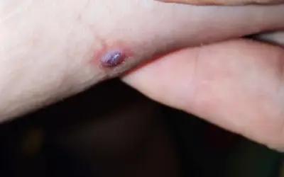 Una piccola piaga da decubito che sanguina, con un'area violacea al centro, su pelle chiara.