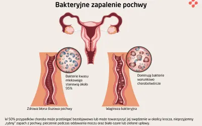 Ilustracja porównuje zdrową pochwę z dominującymi bakteriami kwasu mlekowego do waginozy bakteryjnej, gdzie przeważają bakterie chorobotwórcze.