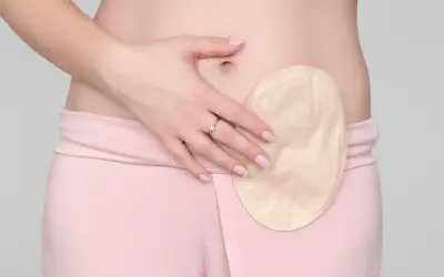 Eine Hand bedeckt einen Teil einer Stoma-Blase, die an der Hüfte einer Person befestigt ist.