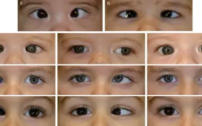 Primeros planos de ojos de bebés y niños pequeños, mostrando diferentes tipos de estrabismo en niños de 1 a 2 años.