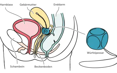 Schema des weiblichen Beckens mit Harnblase, Gebärmutter und Enddarm. Ein Würfelpessar wird gezeigt, dessen Nachteile hier nicht thematisiert werden.