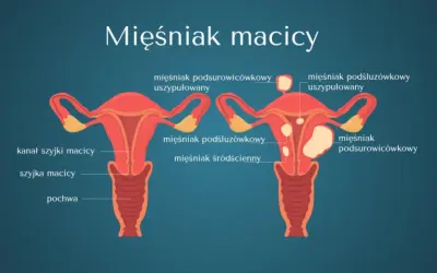 Rosnący mięśniak po menopauzie: Kiedy to sygnał alarmowy?