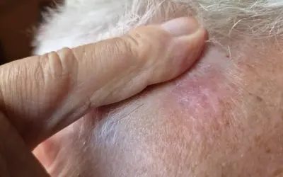 Ein Finger berührt eine gerötete Stelle auf der Kopfhaut, die auf weißen Hautkrebs hindeuten könnte.