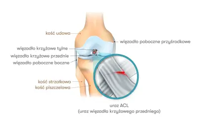 Anatomia kolana z zaznaczonym urazem ACL (przedniego więzadła krzyżowego). Widoczna jest ruptura więzadła.