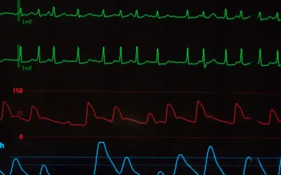Monitor EKG pokazuje nieregularne fale, sugerujące migotanie przedsionków. Widoczne są również linie ciśnienia krwi i pulsoksymetrii.