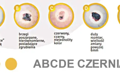 ABCDE czerniaka: asymetria, brzegi, kolor, duży rozmiar, ewolucja. Zmiany na ustach mogą być niepokojące.