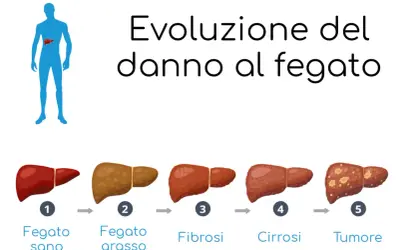 Evoluzione del danno epatico: da fegato sano a fegato grasso, poi fibrosi, cirrosi e infine tumore.