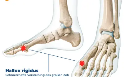 Anatomische Darstellung des Fußskeletts mit Hervorhebung des Gelenks am großen Zeh, das von Hallux rigidus betroffen ist.